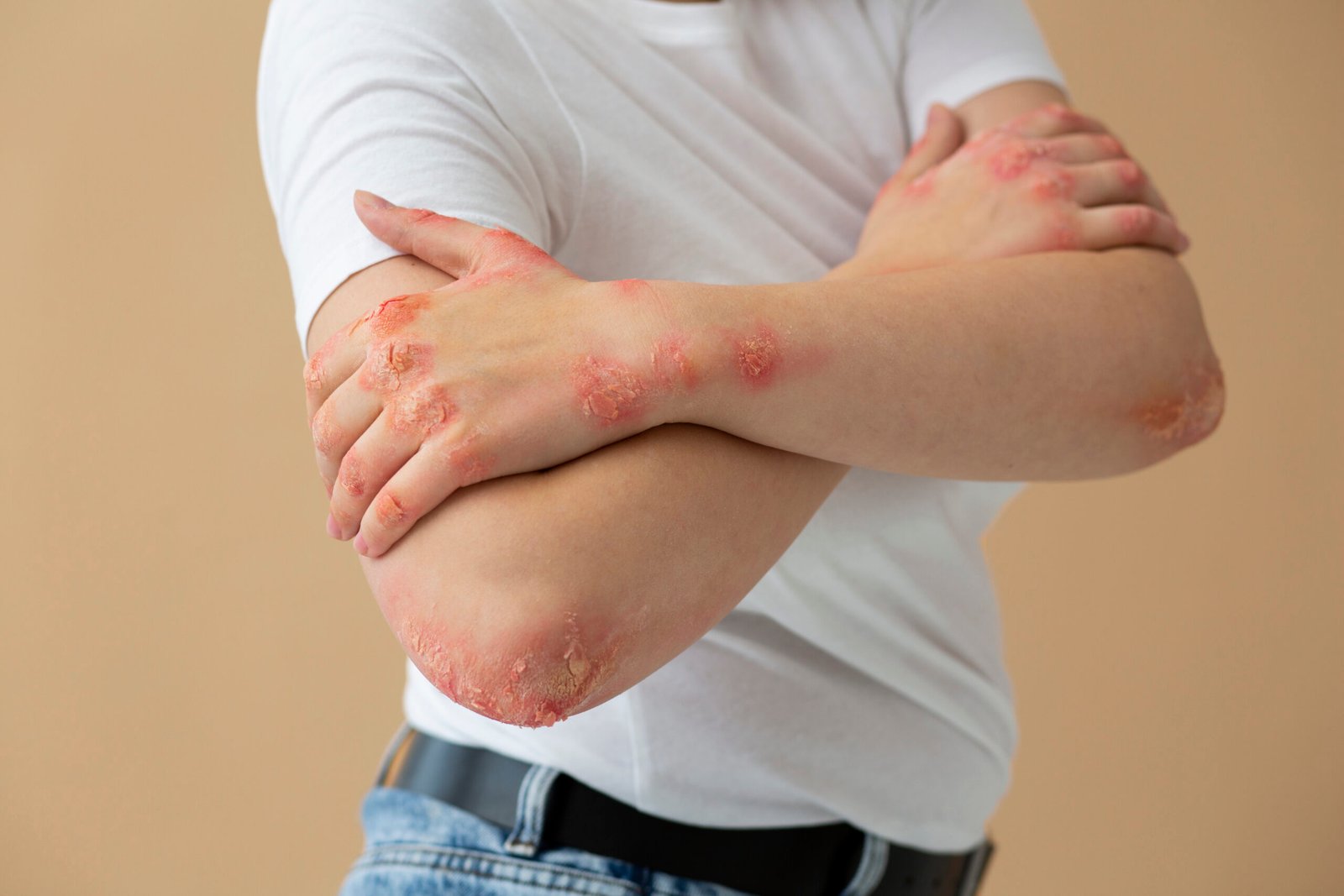 Man suffering from shingles on his arm